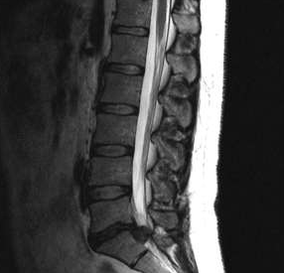 Lumbar Osteokondrosiarentzako diagnostiko aukerak