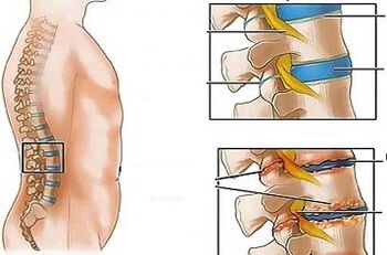 Lumbar osteochondrosisaren garapenaren arrazoiak