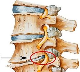 Zergatik da lumbar osteochondrosia