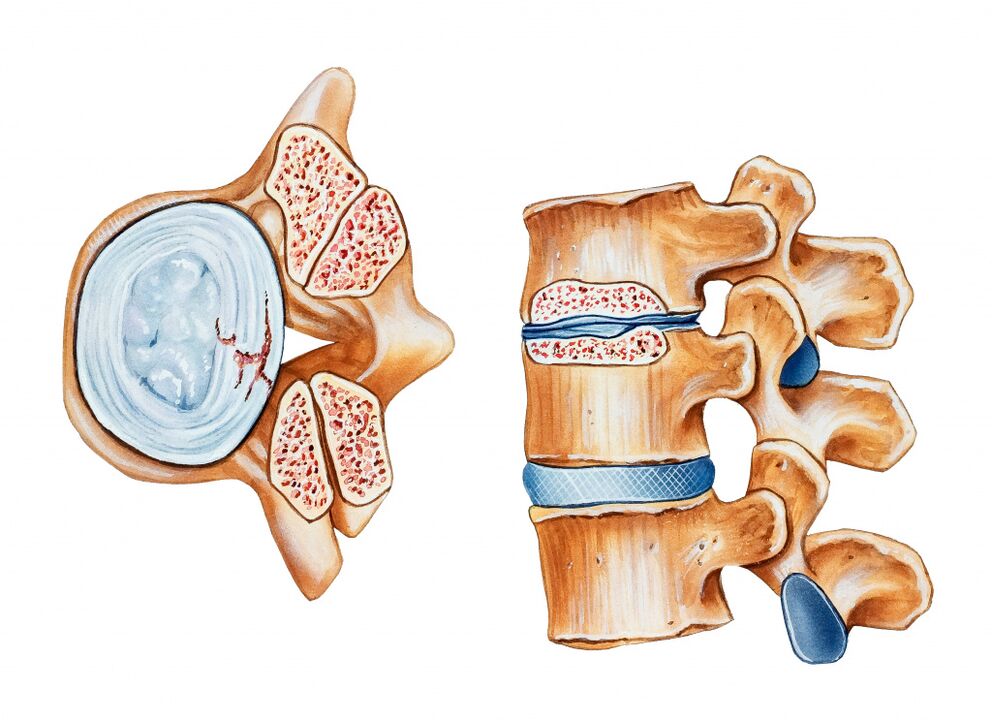 Cervical eskualdearen osteokondrosisak disko intervertebralen suntsipena dakar