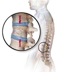 Osteoporosiak bizkarreko mina pizten du bizkarrean
