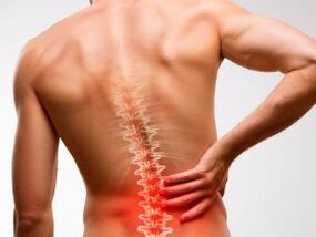 bizkarreko mina osteokondrosiaren ondorioz